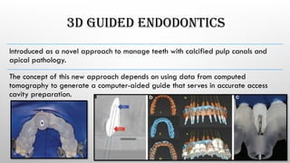 3D GUIDED ENDODONTICS
Introduced as a novel approach to manage teeth with calcified pulp canals and
apical pathology.
The concept of this new approach depends on using data from computed
tomography to generate a computer-aided guide that serves in accurate access
cavity preparation.
 