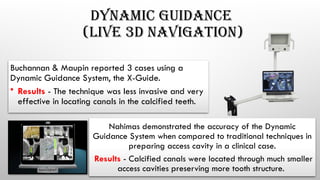 DYNAMIC GUIDANCE
(LIVE 3D NAVIGATION)
Buchannan & Maupin reported 3 cases using a
Dynamic Guidance System, the X-Guide.
• Results - The technique was less invasive and very
effective in locating canals in the calcified teeth.
Nahimas demonstrated the accuracy of the Dynamic
Guidance System when compared to traditional techniques in
preparing access cavity in a clinical case.
Results - Calcified canals were located through much smaller
access cavities preserving more tooth structure.
 