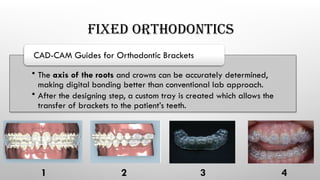 FIXED ORTHODONTICS
• The axis of the roots and crowns can be accurately determined,
making digital bonding better than conventional lab approach.
• After the designing step, a custom tray is created which allows the
transfer of brackets to the patient’s teeth.
CAD-CAM Guides for Orthodontic Brackets
1 2 3 4
 