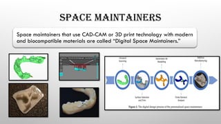 SPACE MAINTAINERS
Space maintainers that use CAD-CAM or 3D print technology with modern
and biocompatible materials are called “Digital Space Maintainers.”
 
