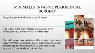 MINIMALLY INVASIVE PERIODONTAL
SURGERY
Originally performed using surgical loupes.
The loupes were later replaced with a glass fibre
endoscope and, more recently, a videoscope.
The video-scope assisted minimally invasive periodontal
surgery (VMIS) permits the use of higher magnification
and smaller incisions than the MIS and enables the
removal of ‘micro islands’ of calculus.
 