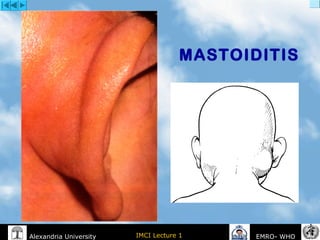 IMCI Lecture 1Alexandria University EMRO- WHO
MASTOIDITIS
 