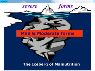 IMCI Lecture 1Alexandria University EMRO- WHO
Mild & Moderate forms
severe               forms
The Iceberg of Malnutrition
 