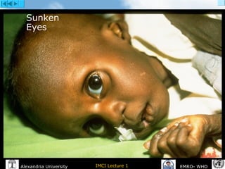 IMCI Lecture 1Alexandria University EMRO- WHO
Sunken
Eyes
 