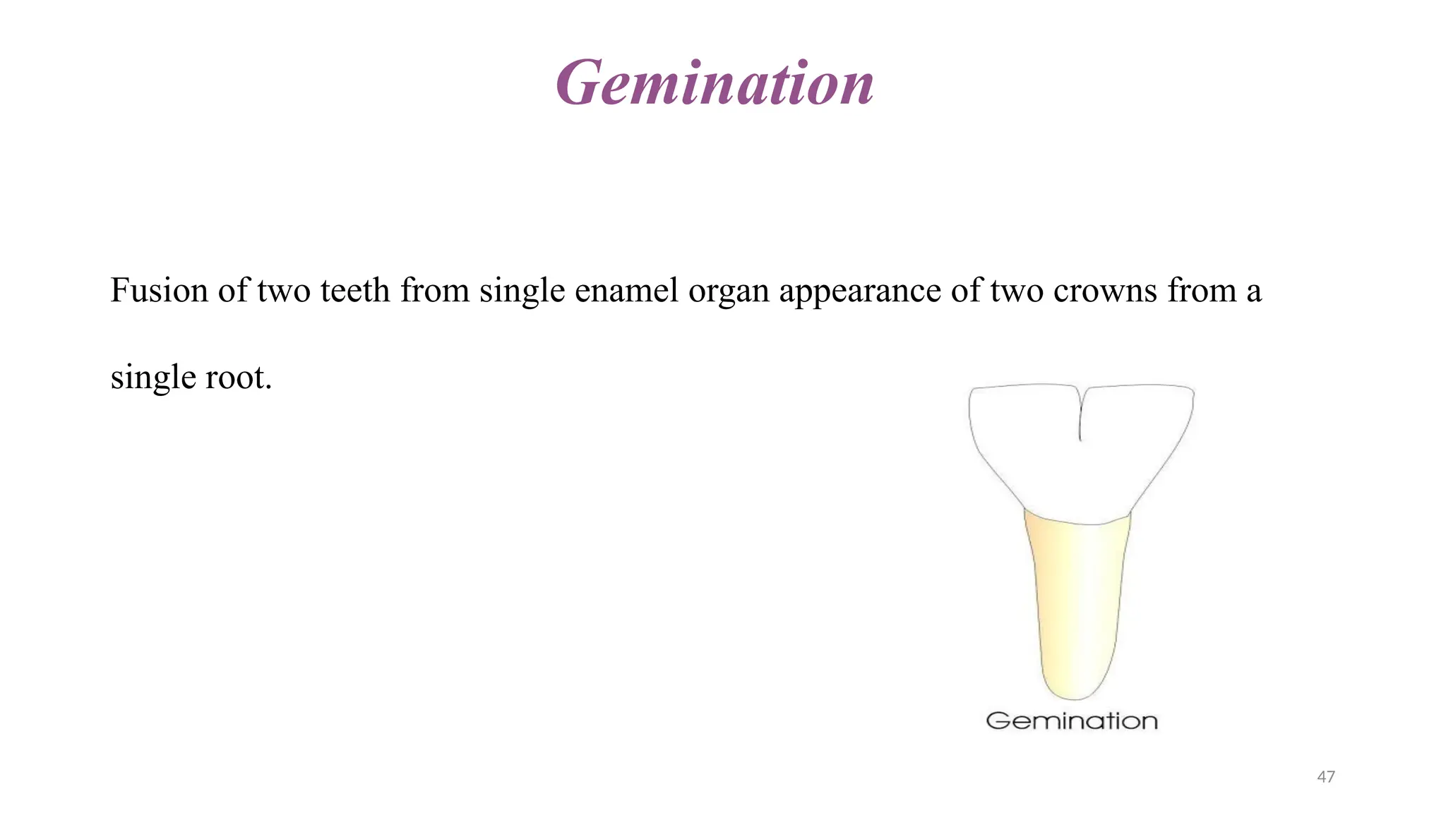 INTEGRATED SUPERNUMERARY TEETH power point presentation | PPTX