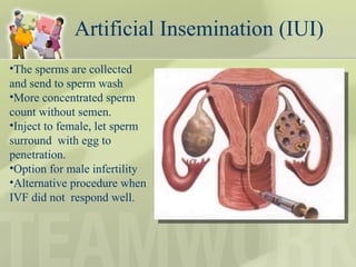 Artificial Insemination (IUI) The sperms are collected and send to sperm wash More concentrated sperm count without semen. Inject to female, let sperm surround  with egg to penetration. Option for male infertility  Alternative procedure when IVF did not  respond well. 