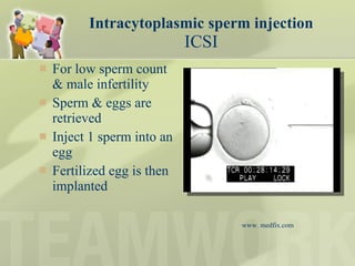 Intracytoplasmic sperm injection ICSI For low sperm count & male infertility Sperm & eggs are retrieved  Inject 1 sperm into an egg Fertilized egg is then implanted  www. medfix.com 