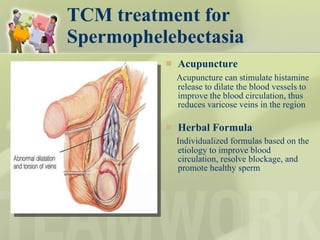 TCM treatment for Spermophelebectasia Acupuncture Acupuncture can stimulate histamine release to dilate the blood vessels to improve the blood circulation, thus reduces varicose veins in the region Herbal Formula   Individualized formulas based on the  etiology to improve blood circulation, resolve blockage, and promote healthy sperm  