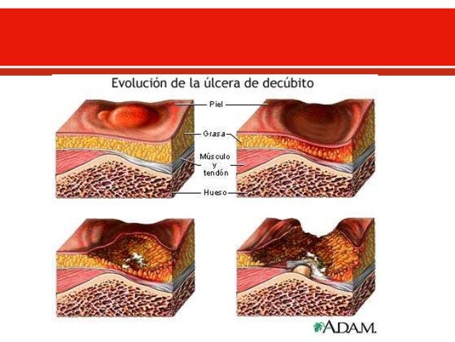 Integridad cutánea y_el_cuidado_de_las_heridas[1] FEV