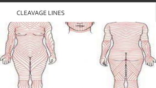 CLEAVAGE LINES
 