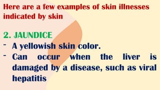 Here are a few examples of skin illnesses
indicated by skin
2. JAUNDICE
- A yellowish skin color.
- Can occur when the liver is
damaged by a disease, such as viral
hepatitis
 