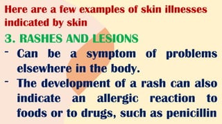 Here are a few examples of skin illnesses
indicated by skin
3. RASHES AND LESIONS
- Can be a symptom of problems
elsewhere in the body.
- The development of a rash can also
indicate an allergic reaction to
foods or to drugs, such as penicillin
 