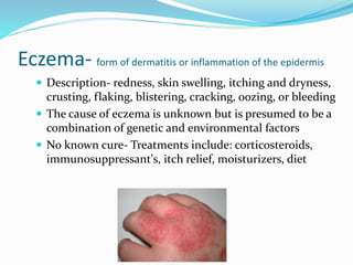 Eczema- form of dermatitis or inflammation of the epidermis
 Description- redness, skin swelling, itching and dryness,
crusting, flaking, blistering, cracking, oozing, or bleeding
 The cause of eczema is unknown but is presumed to be a
combination of genetic and environmental factors
 No known cure- Treatments include: corticosteroids,
immunosuppressant's, itch relief, moisturizers, diet
 
