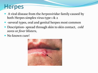 Herpes
 A viral disease from the herpesviridae family caused by
both Herpes simplex virus type 1 & 2
 -several types, oral and genital herpes most common
 Description- spread through skin to skin contact, cold
sores or fever blisters,
 No known cure!
 