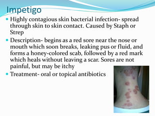 Impetigo
 Highly contagious skin bacterial infection- spread
through skin to skin contact. Caused by Staph or
Strep
 Description- begins as a red sore near the nose or
mouth which soon breaks, leaking pus or fluid, and
forms a honey-colored scab, followed by a red mark
which heals without leaving a scar. Sores are not
painful, but may be itchy
 Treatment- oral or topical antibiotics
 