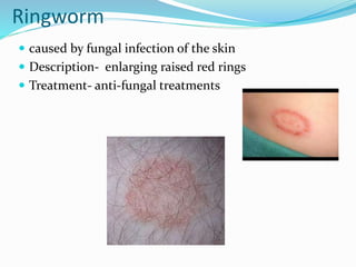 Ringworm
 caused by fungal infection of the skin
 Description- enlarging raised red rings
 Treatment- anti-fungal treatments
 