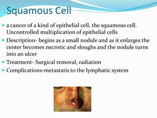 Squamous Cell
 a cancer of a kind of epithelial cell, the squamous cell.
Uncontrolled multiplication of epithelial cells
 Description- begins as a small nodule and as it enlarges the
center becomes necrotic and sloughs and the nodule turns
into an ulcer
 Treatment- Surgical removal, radiation
 Complications-metastatis to the lymphatic system
 