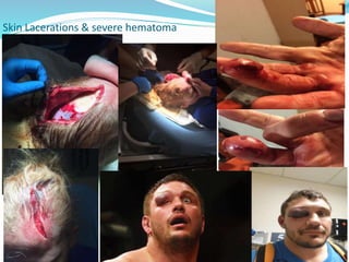 Skin Lacerations & severe hematoma
 