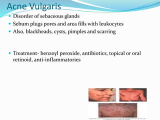 Acne Vulgaris
 Disorder of sebaceous glands
 Sebum plugs pores and area fills with leukocytes
 Also, blackheads, cysts, pimples and scarring
 Treatment- benzoyl peroxide, antibiotics, topical or oral
retinoid, anti-inflammatories
 