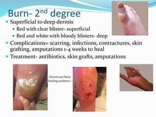 Burn- 2nd degree
 Superficial to deep dermis
 Red with clear blister- superficial
 Red and white with bloody blisters- deep
 Complications= scarring, infections, contractures, skin
grafting, amputations 1-4 weeks to heal
 Treatment- antibiotics, skin grafts, amputations
• --Severe sun burn
• Healing sunburn---
 