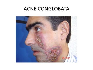 ACNE CONGLOBATA
 