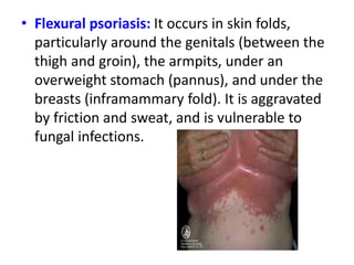 • Flexural psoriasis: It occurs in skin folds,
particularly around the genitals (between the
thigh and groin), the armpits, under an
overweight stomach (pannus), and under the
breasts (inframammary fold). It is aggravated
by friction and sweat, and is vulnerable to
fungal infections.
 