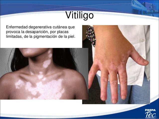 La mejor crema que blanquea del postacné las revocaciones