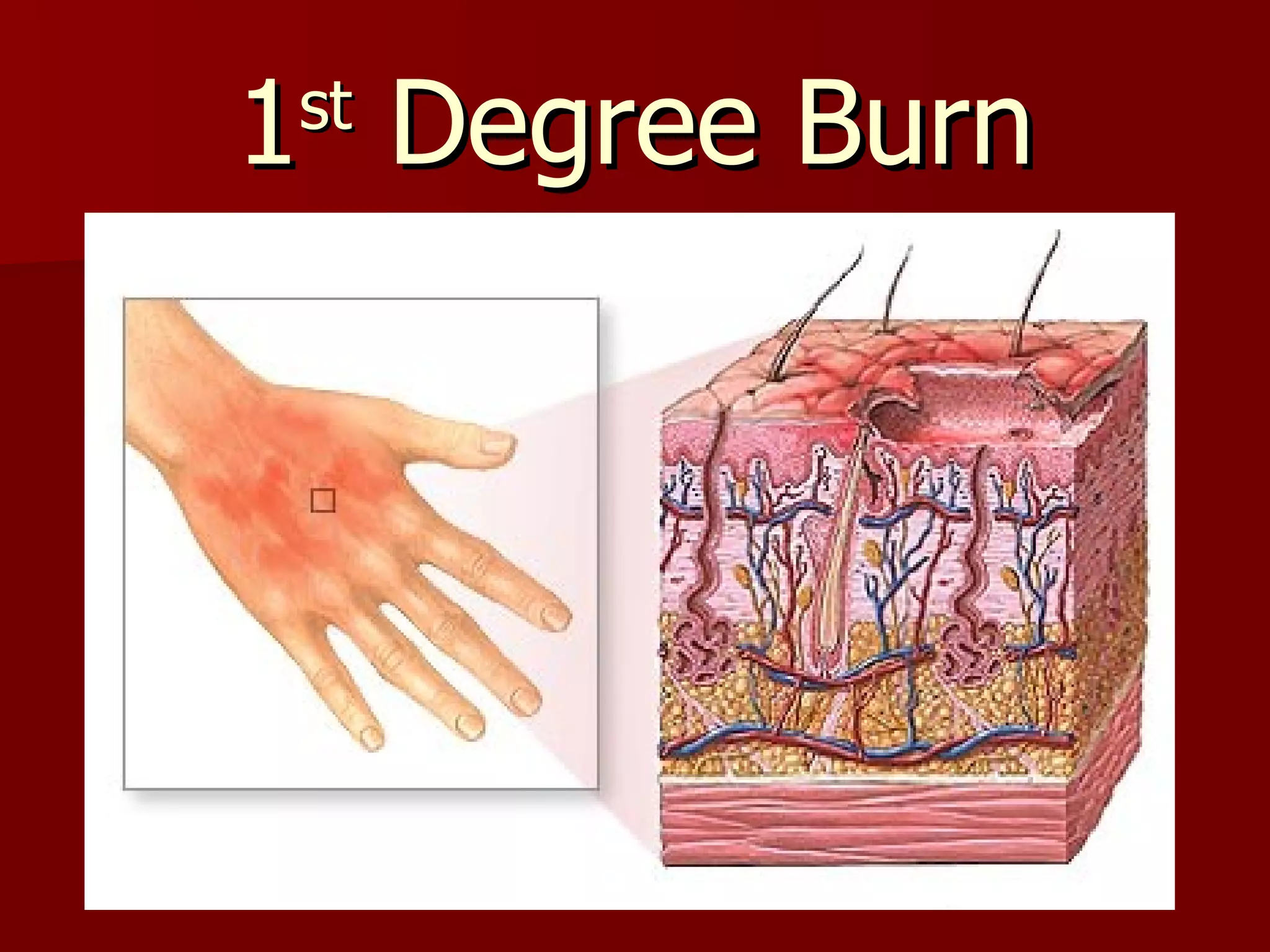 1 st  Degree Burn 