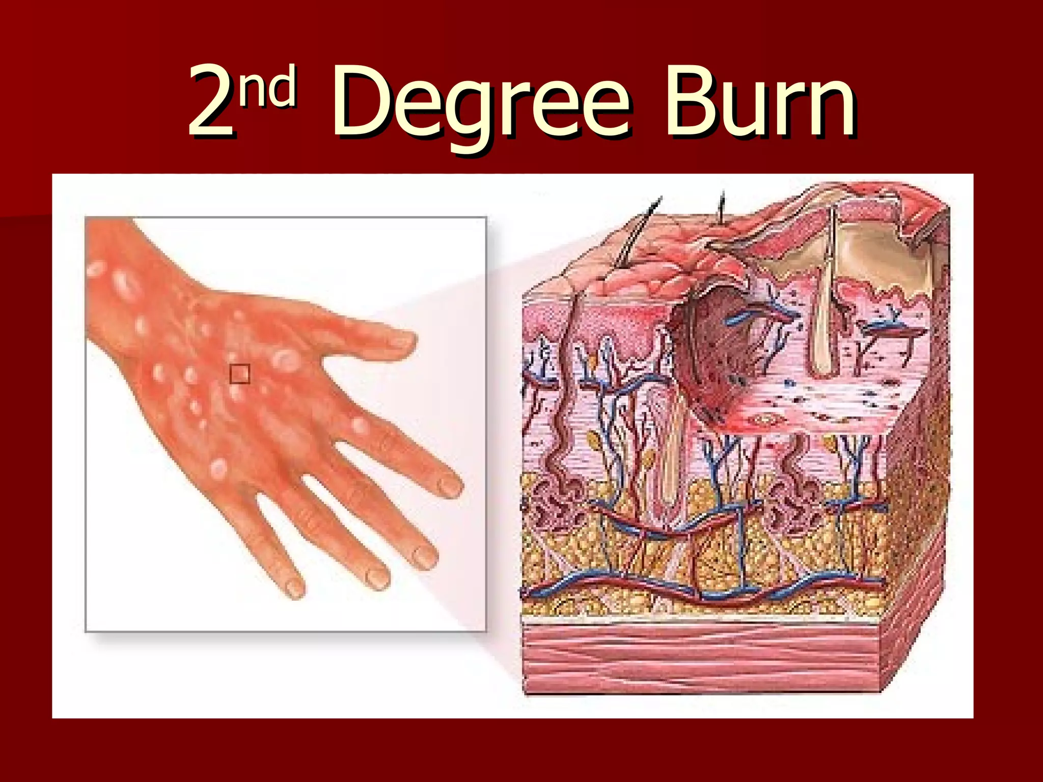2 nd  Degree Burn 