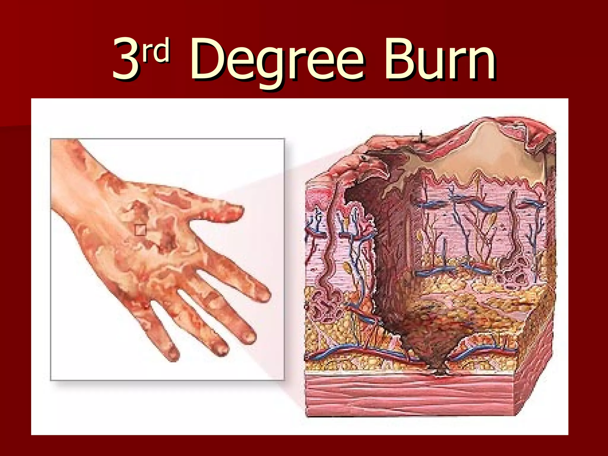 3 rd  Degree Burn 