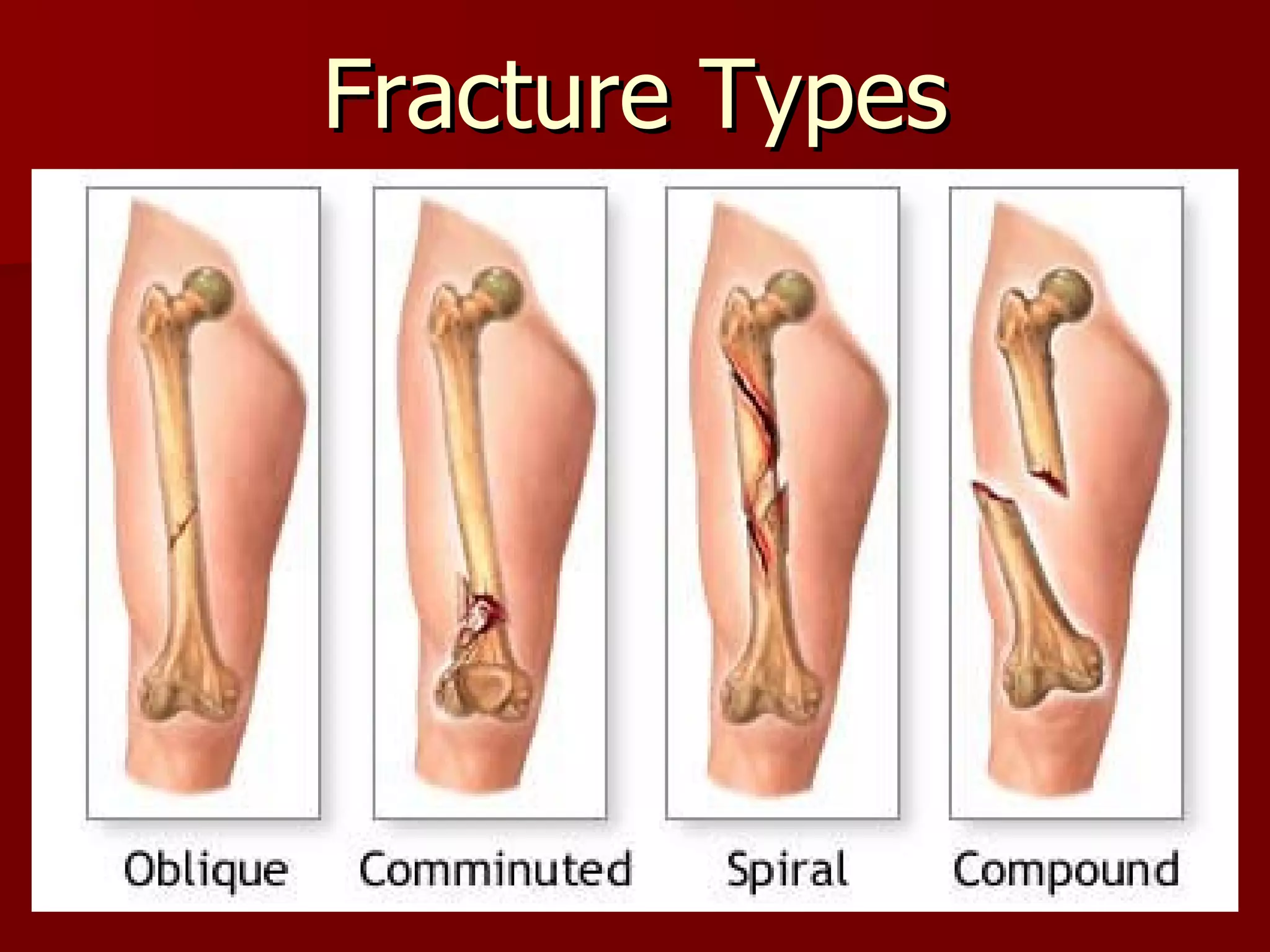Fracture Types 
