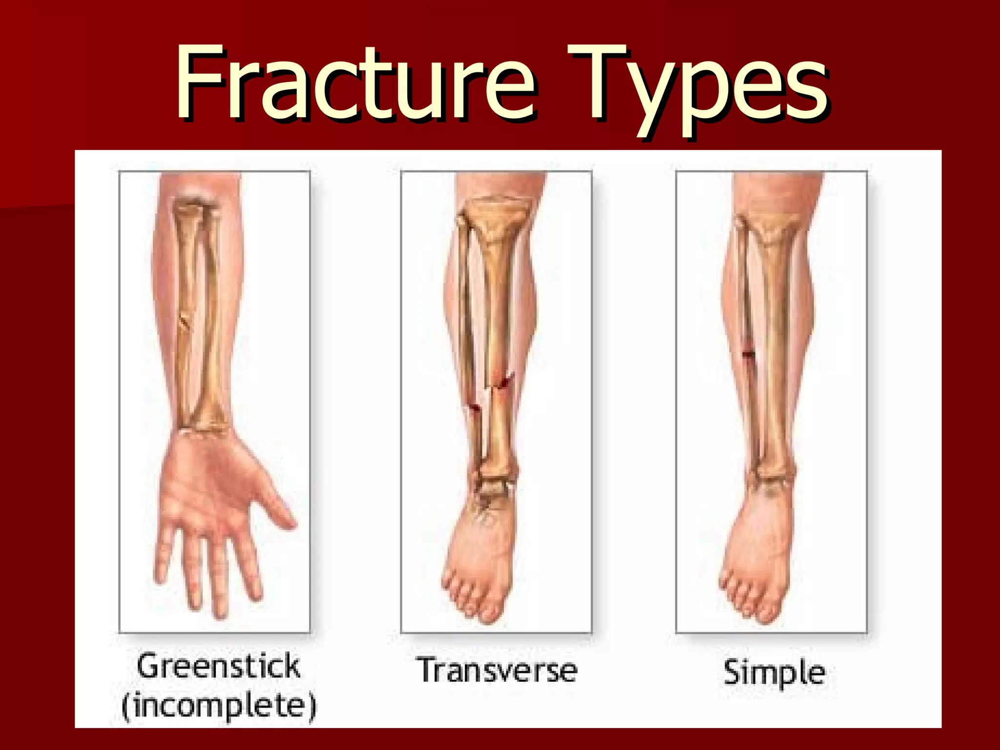Fracture Types 