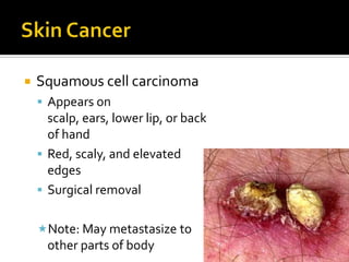 Skin CancerBasal cell carcinomaMost commonLeast dangerousUsually on faceAppearance is small, shiny, and enlarges with pearly edgeTreatment: surgical removal