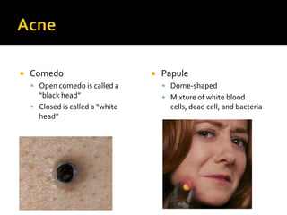 AcneComedoOpen comedo is called a “black head”Closed is called a “white head”PapuleDome-shapedMixture of white blood cells, dead cell, and bacteria
