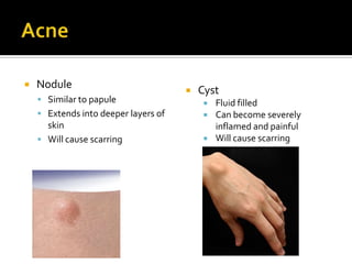 AcneNoduleSimilar to papuleExtends into deeper layers of skinWill cause scarringCyst