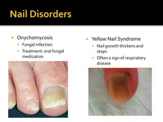 Nail DisordersOnychomycosisFungal infectionTreatment: oral fungal medicationYellow Nail SyndromeNail growth thickens and stopsOften a sign of respiratory disease