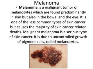 MelanomaMelanoma is a malignant tumor of melanocytes which are found predominantly in skin but also in the bowel and the eye. It is one of the less common types of skin cancer but causes the majority of skin cancer related deaths. Malignant melanoma is a serious type of skin cancer. It is due to uncontrolled growth of pigment cells, called melanocytes.