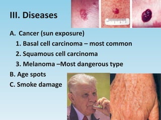 III. DiseasesCancer (sun exposure) 1. Basal cell carcinoma – most common 2. Squamouscell carcinoma 3. Melanoma –Most dangerous typeB. Age spotsC. Smoke damage
