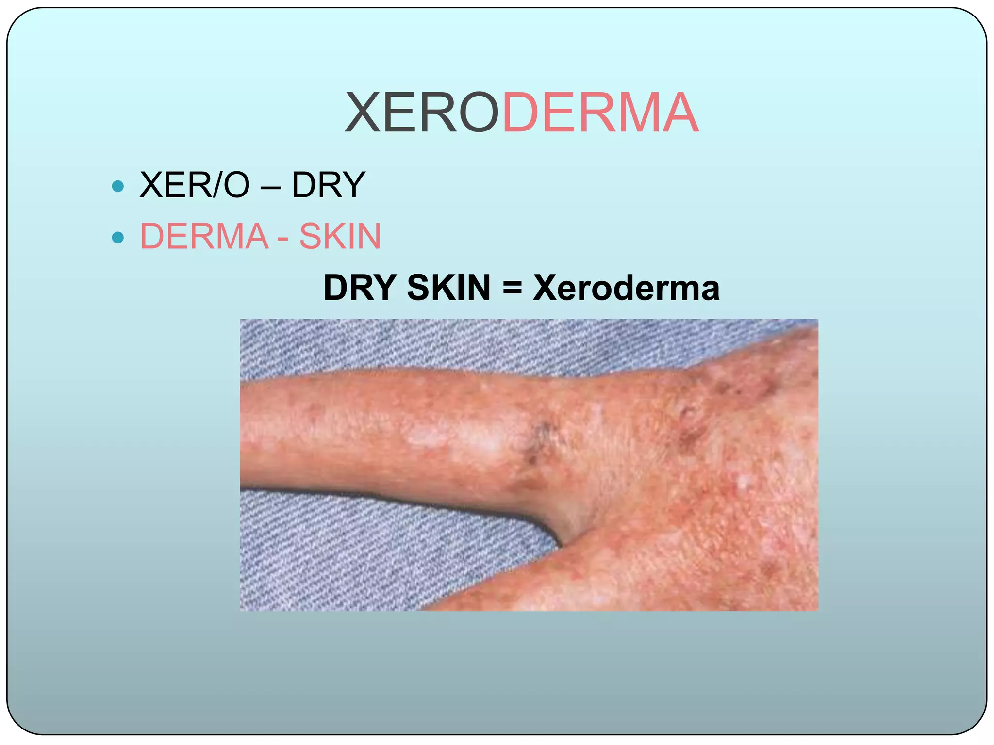 XERODERMA
 XER/O – DRY
 DERMA - SKIN
          DRY SKIN = Xeroderma
 