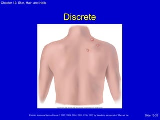 Chapter 1122:: SSkkiinn,, HHaaiirr,, aanndd NNaaiillss 
DDiissccrreettee 
Elsevier items and derived items © 2012, 2008, 2004, 2000, 1996, 1992 by Saunders, an imprint of Elsevier Inc. 
Slide 12-26 
 