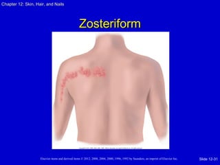 Chapter 1122:: SSkkiinn,, HHaaiirr,, aanndd NNaaiillss 
ZZoosstteerriiffoorrmm 
Elsevier items and derived items © 2012, 2008, 2004, 2000, 1996, 1992 by Saunders, an imprint of Elsevier Inc. 
Slide 12-31 
 