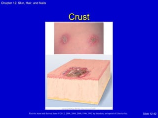 Chapter 1122:: SSkkiinn,, HHaaiirr,, aanndd NNaaiillss 
CCrruusstt 
Elsevier items and derived items © 2012, 2008, 2004, 2000, 1996, 1992 by Saunders, an imprint of Elsevier Inc. 
Slide 12-42 
 