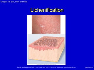 Chapter 1122:: SSkkiinn,, HHaaiirr,, aanndd NNaaiillss 
LLiicchheenniiffiiccaattiioonn 
Elsevier items and derived items © 2012, 2008, 2004, 2000, 1996, 1992 by Saunders, an imprint of Elsevier Inc. 
Slide 12-50 
 