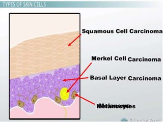 Squamous Cell
Merkel Cell
Basal Layer
Melanocytes
Carcinoma
Carcinoma
Carcinoma
Melanoma
