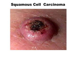 Squamous Cell Carcinoma