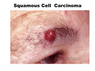 Squamous Cell Carcinoma