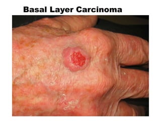 Basal Layer Carcinoma