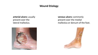 Wound Etiology
arterial ulcers: usually
present over the
lateral malleolus.
venous ulcers: commonly
present over the medial
malleolus or dorsum of the foot.
 