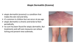 Atopic Dermatitis (Eczema)
 atopic dermatitis (eczema) is a condition that
makes the skin red and itchy.
 it's common in children but can occur at any age.
 atopic dermatitis is chronic and tends to flare
periodically.
 no cure has been found for atopic dermatitis. But
treatments and self-care measures can relieve
itching and prevent new outbreaks.
 