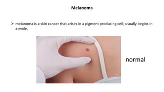 Melanoma
 melanoma is a skin cancer that arises in a pigment producing cell; usually begins in
a mole.
normal
 
